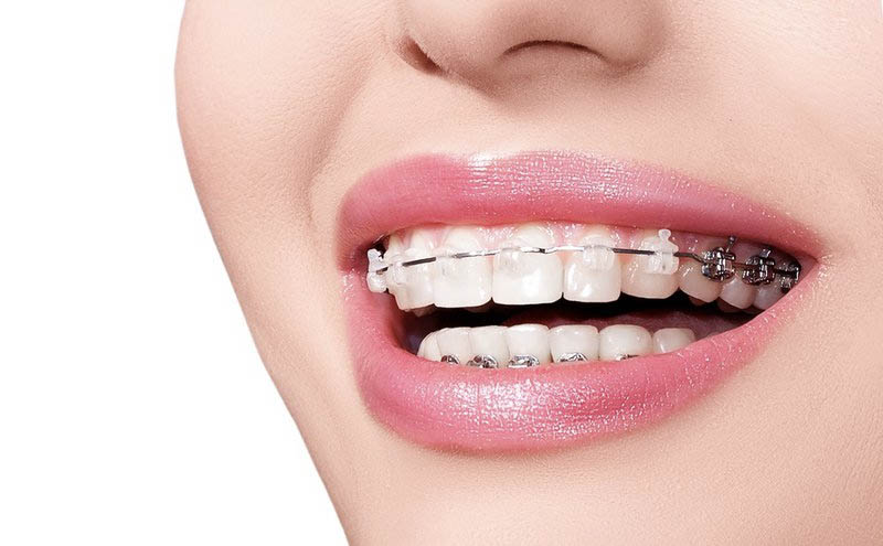 Niềng răng là gì? Răng như thế nào thì nên niềng răng? 