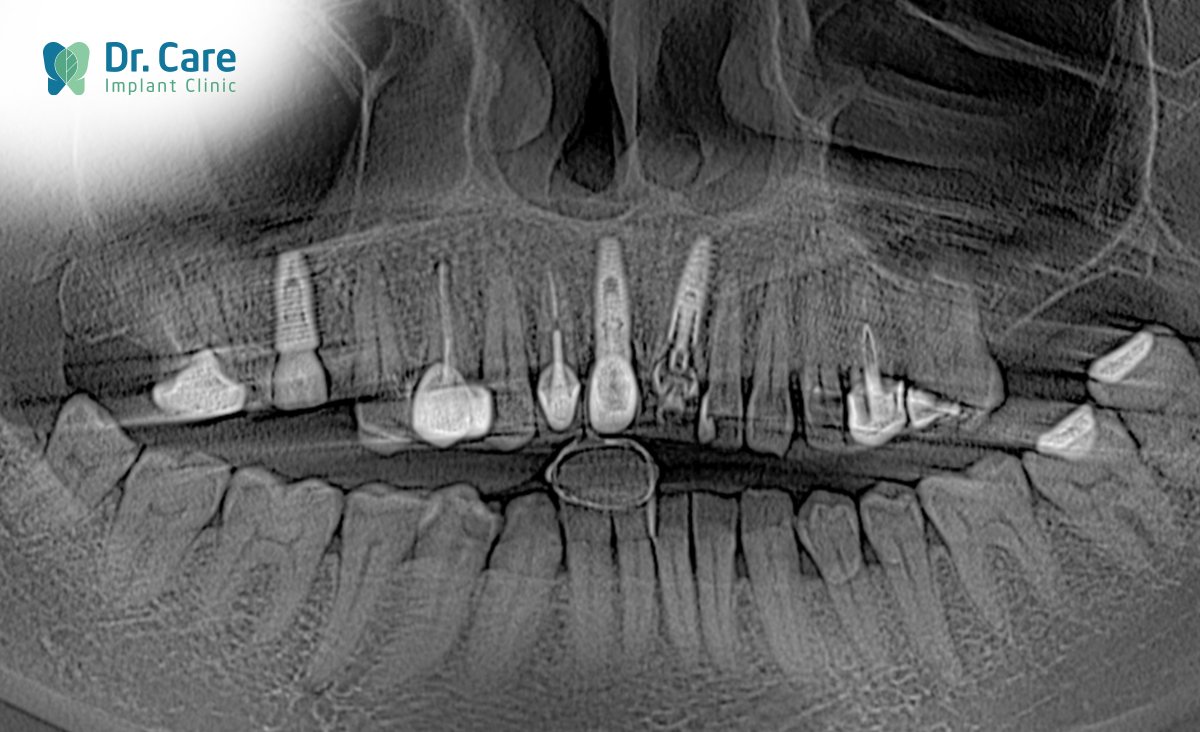 Từ phim X-quang cho thấy trụ Implant ở vùng răng cửa của Ng. Th bị nứt gãy. Hậu quả khiến chị ăn nhai đau đớn, cười nói ngượng ngùng. 