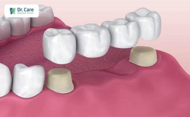 Phương pháp làm cầu răng sứ là gì?