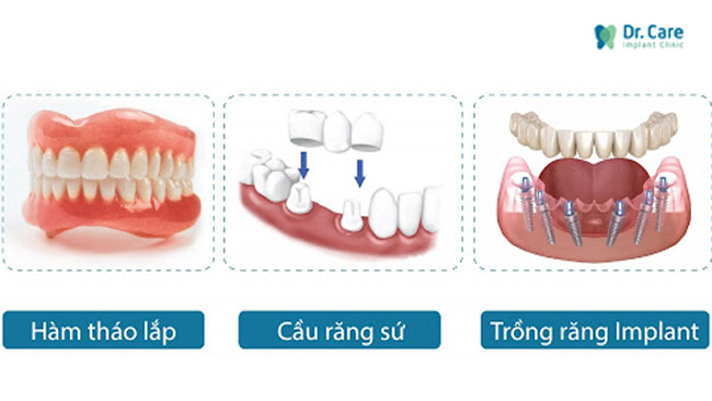 Phương pháp implant nha khoa khắc phục hầu hết các nhược điểm của các phương pháp phục hồi răng truyền thống