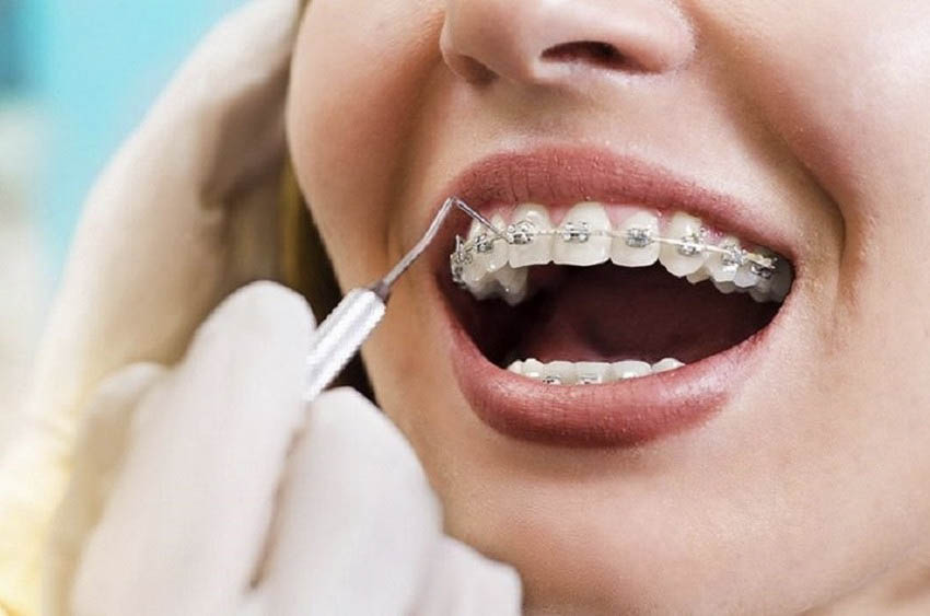 Quy trình niềng răng - chỉnh nha cơ bản