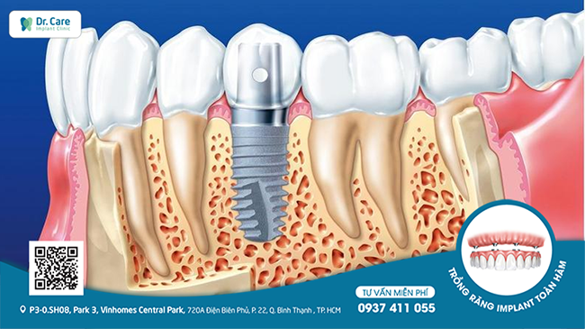 Cấy ghép Implant là phương pháp phục hồi răng đã mất tiên tiến nhất hiện nay