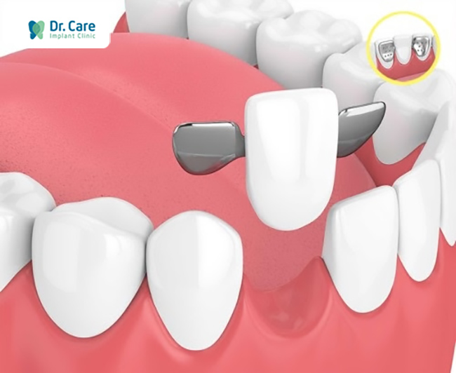 Răng tạm trên abutment tạm: Răng tạm đặt trên một abutment tạm và được kết nối với trụ implant phía dưới bằng vis.