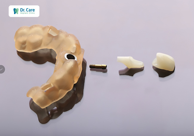 Phục hình răng tạm tức thì trên Abutment sứ được thiết kế theo tiêu chuẩn CAD - CAM.