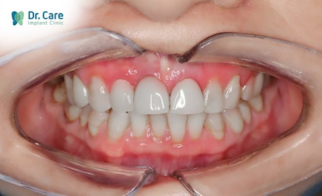 Mất răng bao lâu thì trồng răng giả được
