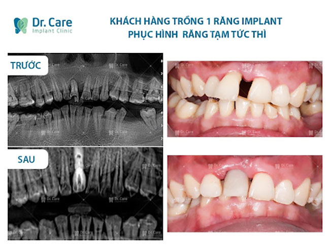 Khách hàng trồng răng phục hình tức thì với răng tạm trên implant tại Dr. Care