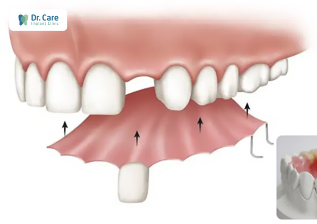 Răng tạm trên implant là gì? Có nên thực hiện không? | Dr. Care