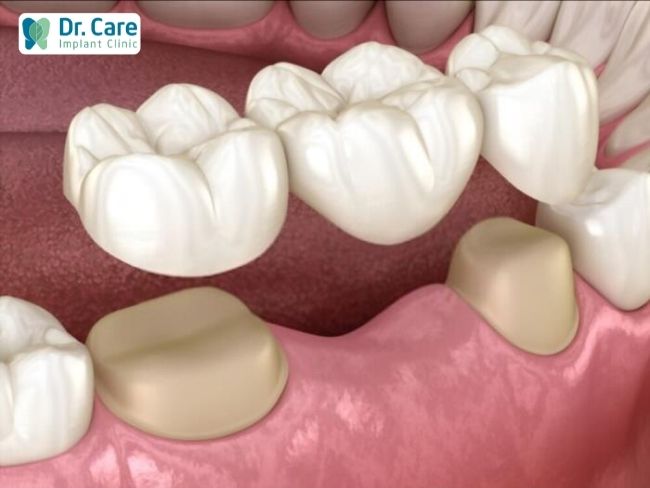 Ưu và nhược điểm của các loại răng giả tạm thời