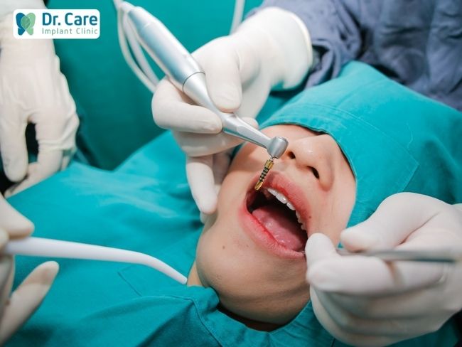 Răng giả tạm thời khi trồng răng Implant