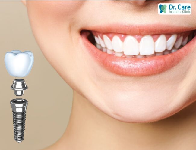 Tại sao trồng răng Implant mới giúp khắc phục được tình trạng móm do mất răng?