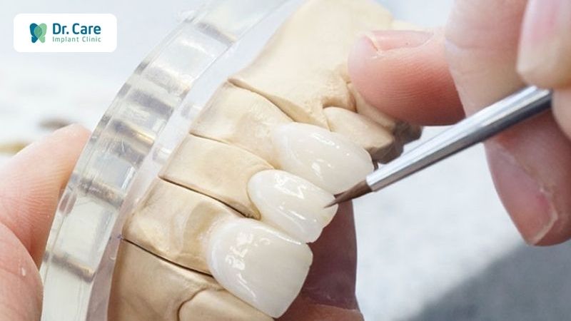 Kỹ thuật chế tác răng sứ