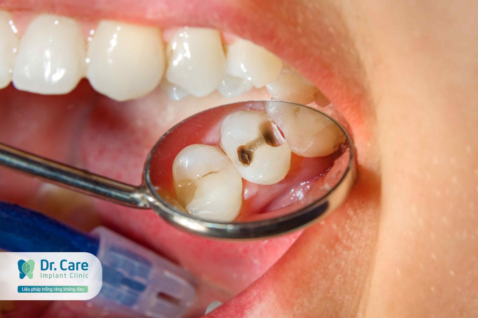 cách phát hiện sâu răng dễ thấy nhất
