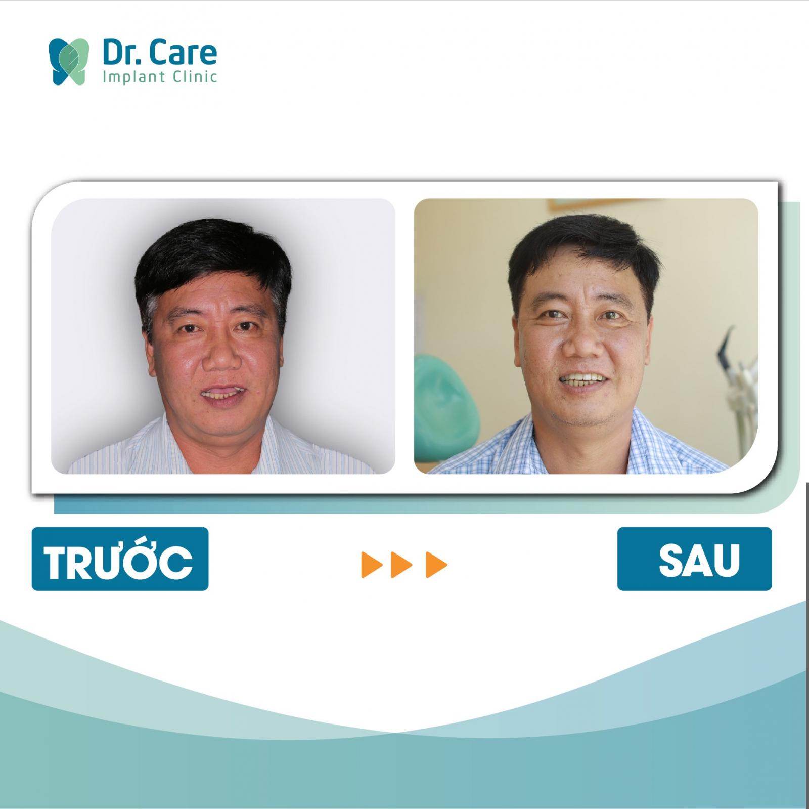 mất răng cửa