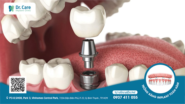 Răng implant nếu đặt đúng vị trí có thể làm điểm neo cho các răng còn lại