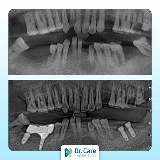 Cầu răng Implant cho trường hợp mất một vài răng.
