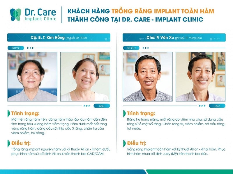 Hình ảnh trước và sau khi áp dụng liệu pháp trồng răng Implant không đau tại Dr. Care của Cô Chú
