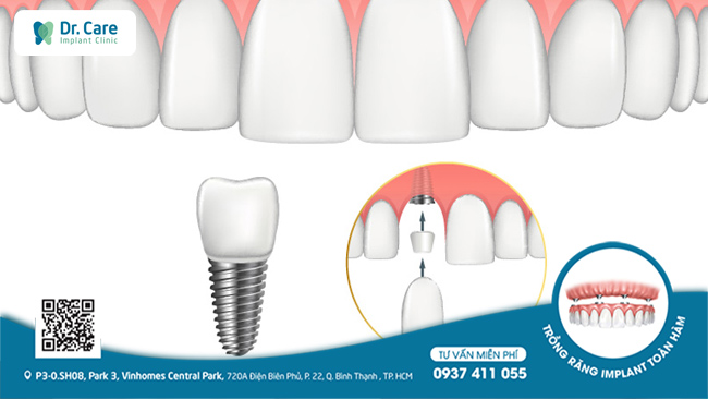 Răng implant cũng có thể đóng vai trò như một điểm neo để có thể tác động một lực nhất định cho các răng còn lại vào đúng vị trí hơn. 