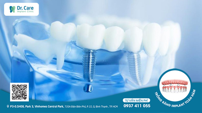 Sau khi hoàn tất quá trình trồng răng implant khách hàng có thể ăn nhai gần như 90% răng thật