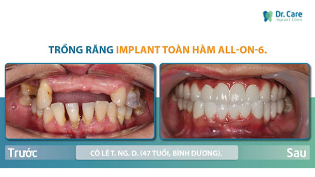 Trồng răng implant toàn hoàn ALL ON 6 tại nha khoa Dr. Care