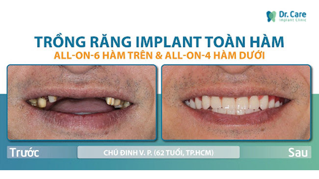 Trồng răng Implant toàn hàm: ALL ON 6 hàm trên và ALL ON 4 hàm dưới