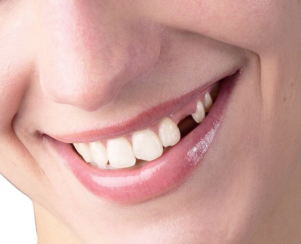 Trồng răng nanh bao nhiêu tiền và phương pháp nào tốt nhất? 