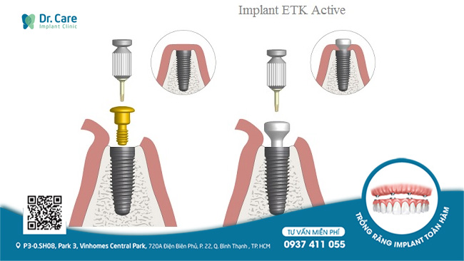 Kết nối giữa trụ Implant ETK Active và abutment khít sát, giảm thiểu tình trạng tiêu xương ở vùng cổ Implant