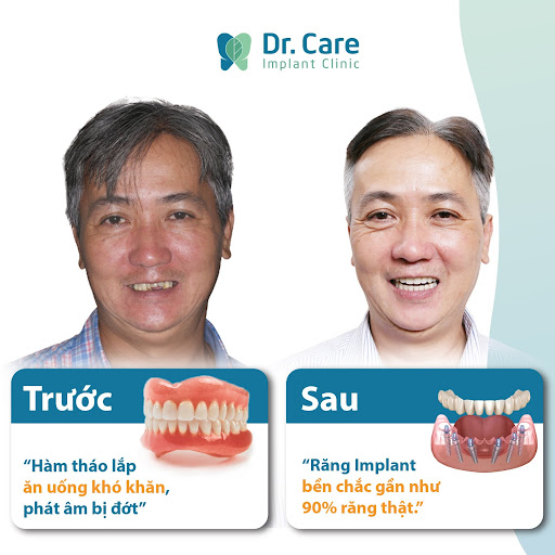 Anh: Hồ Viết Đông Sơn lựa chọn trồng răng Implant để khắc phục những khuyến điểm của phương pháp hàm tháo lắp lúc trước