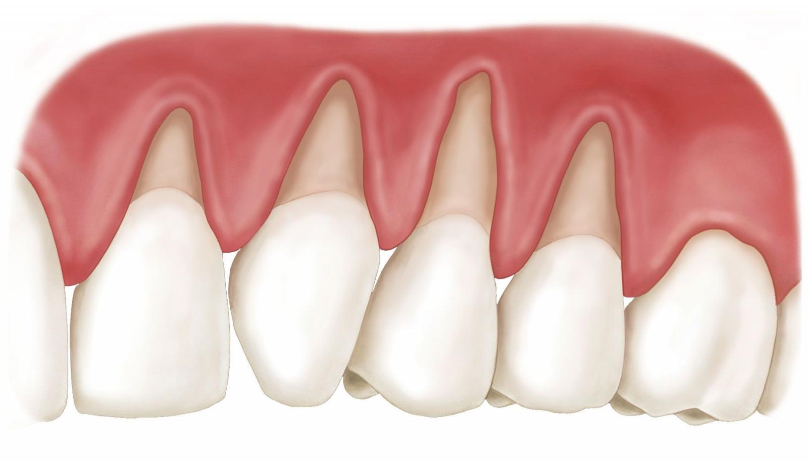 Nguyên nhân gây tụt nướu răng và cách chữa trị hiệu quả