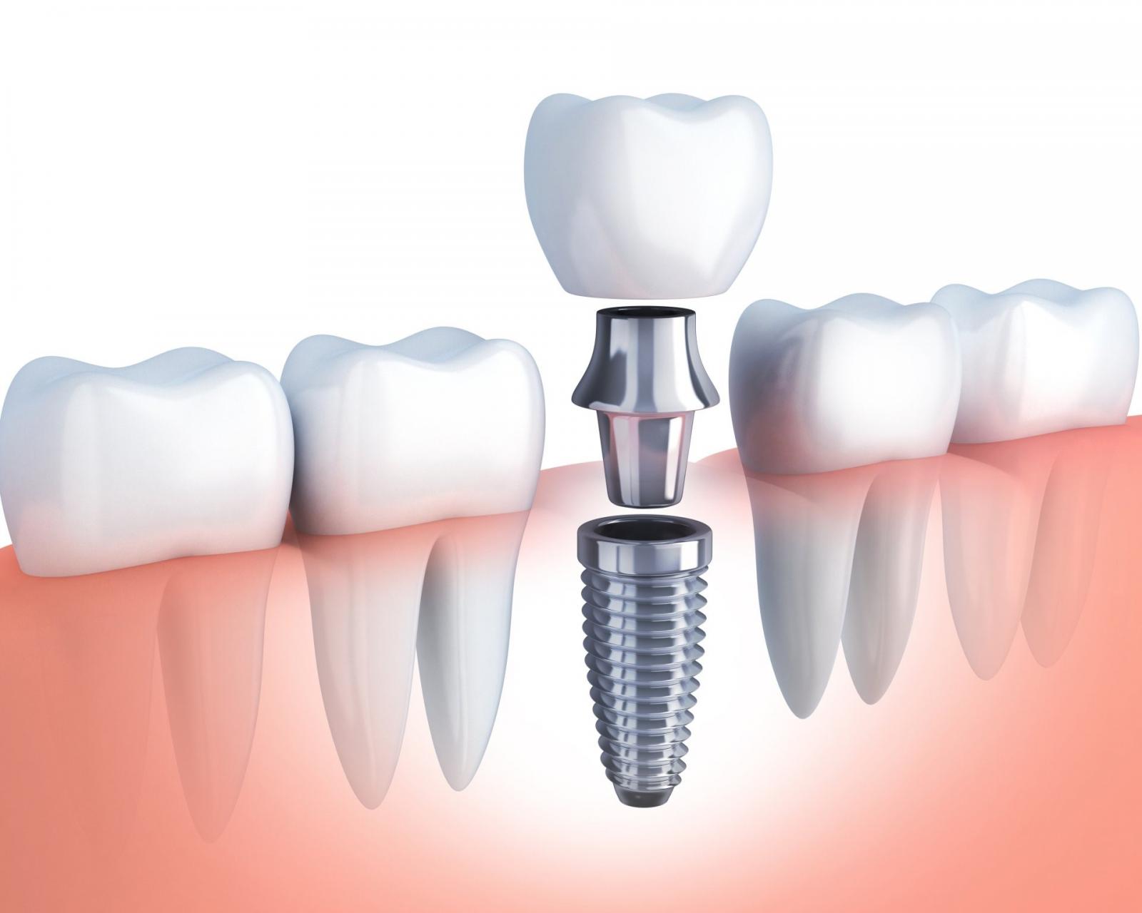 Nguyên nhân gây tụt nướu răng và cách chữa trị hiệu quả