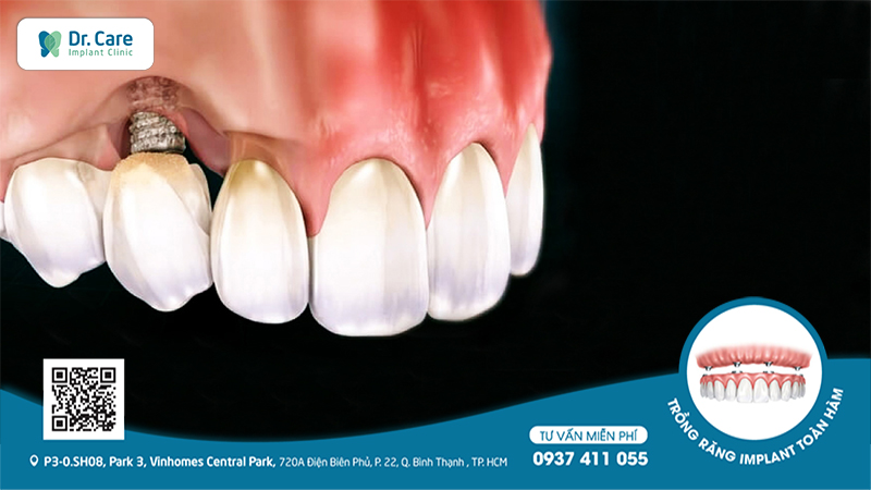 Trồng răng Iimplant giá rẻ có thể dẫn đến nguy cơ đào thải implant