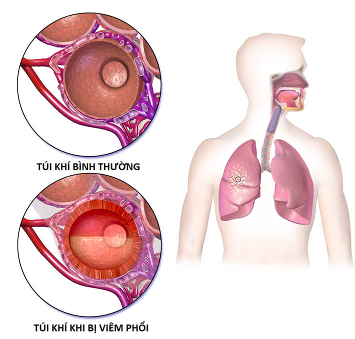 Viêm phổi do vi-rút gây ra là một trong những nguyên nhân gây giảm nồng độ o-xy trong máu