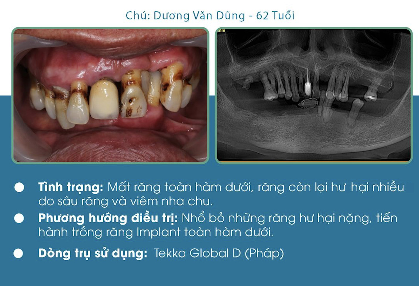 Rụng răng do bệnh lý răng miệng