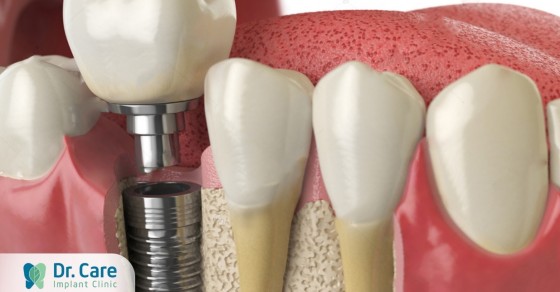 Quá trình trồng răng Implant thường diễn ra như thế nào?
