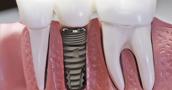 Trong quá trình trồng răng sứ, có cần mài răng gốc không?
