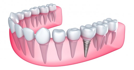 Có cách nào để rút ngắn thời gian chờ đợi trụ implant tích hợp với xương hàm?
