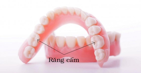 Răng cấm có nặng nề cần nhổ ngay không, hay có thể lưu lại trong trường hợp nào?
