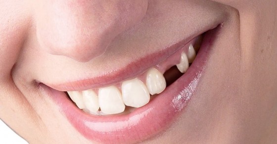 Hiệu quả của phương pháp trồng răng nanh?
