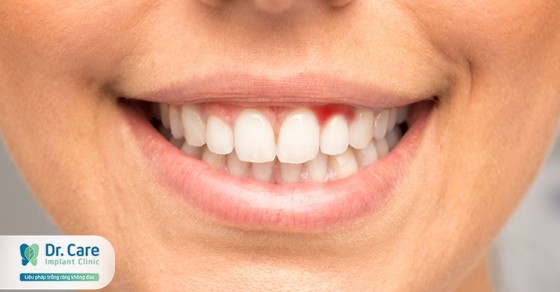 Phòng ngừa sưng nướu răng hiệu quả như thế nào?

