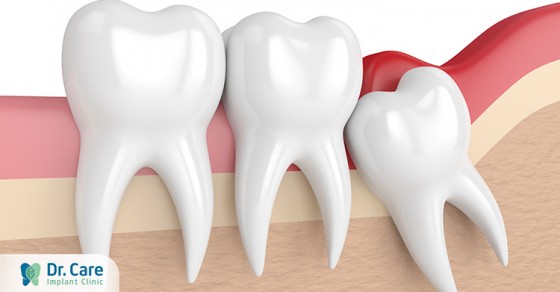 Quá trình mọc răng khôn kéo dài trong khoảng thời gian bao lâu?
