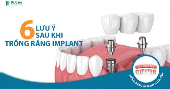 Cần những lưu ý gì khi hút thuốc lá sau khi trồng răng implant?
