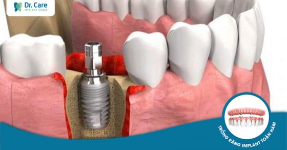 Có yêu cầu gì về tuổi tác để trồng implant?
