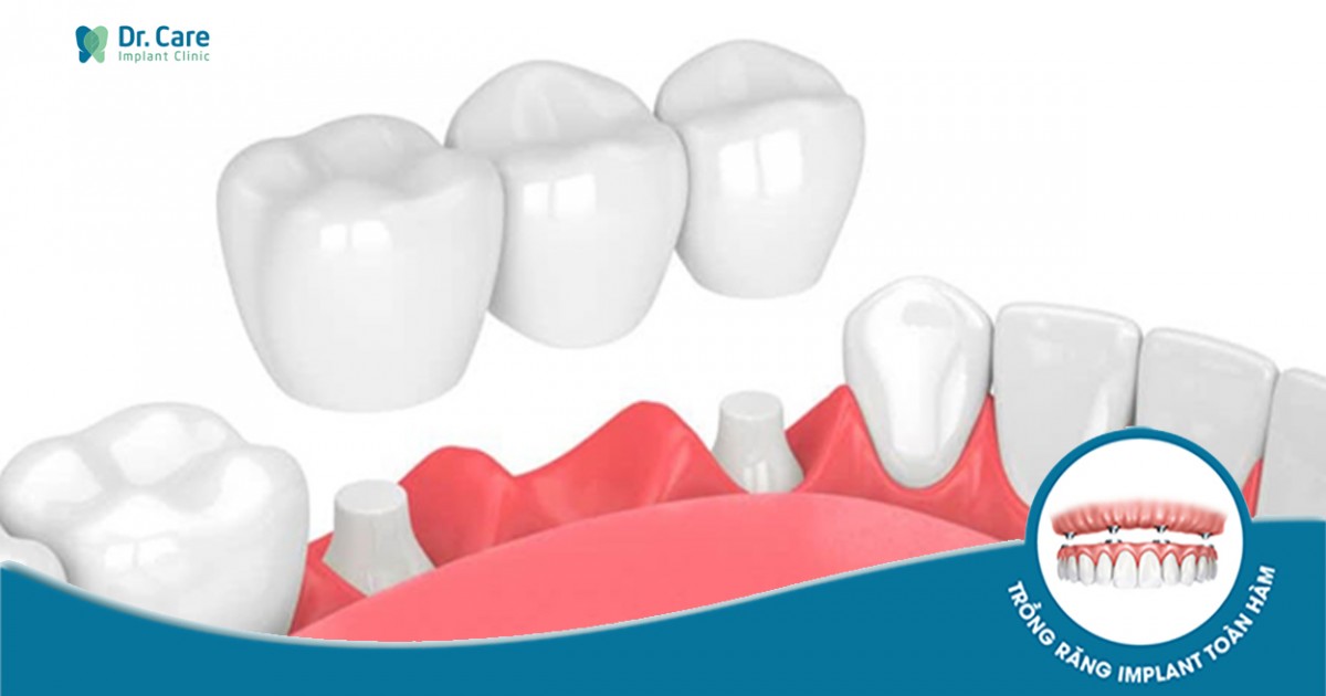 Cầu răng sứ có hạn chế đối tượng sử dụng như thế nào?
