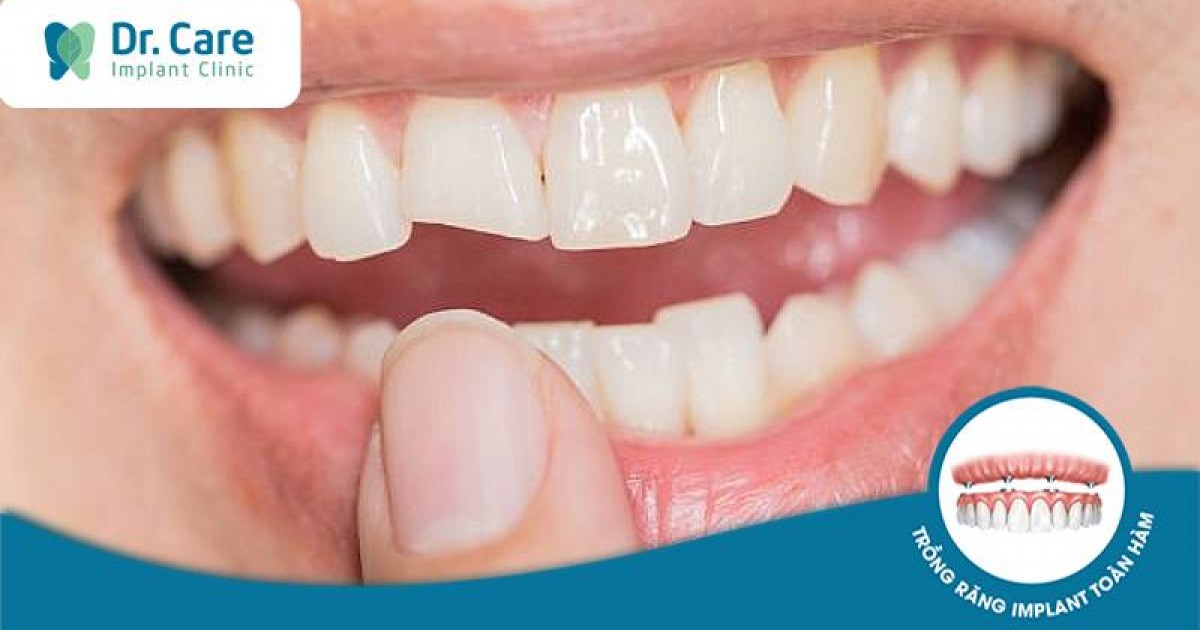 Răng bị sâu vỡ chỉ còn chân có ảnh hưởng đến chức năng ăn nhai không?
