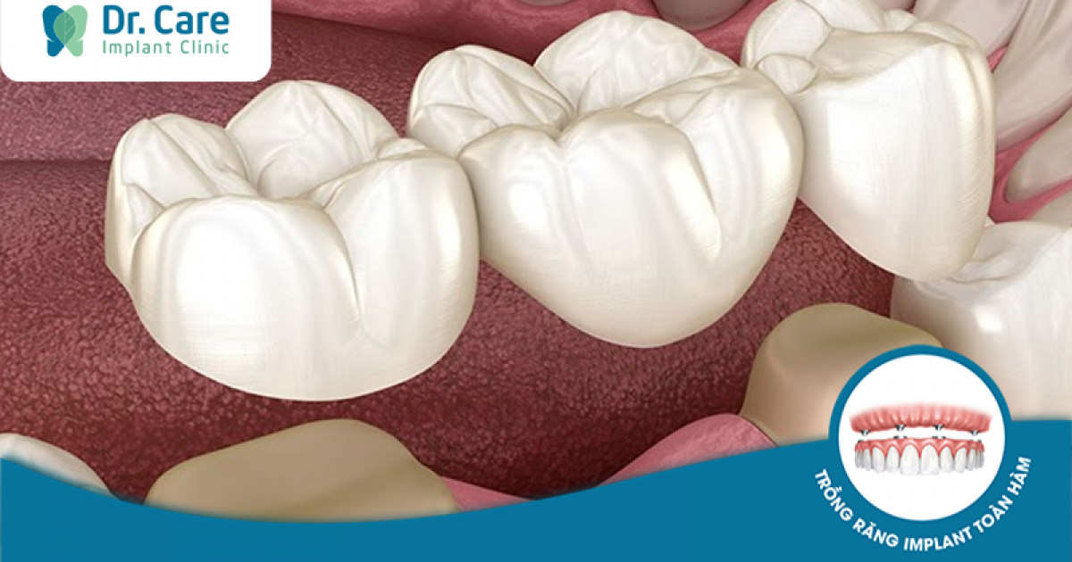 Quy trình làm cầu răng sứ bao gồm những giai đoạn nào?
