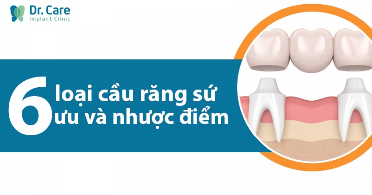 Có những nguy cơ hay tác động phụ nào liên quan đến cầu răng sứ?
