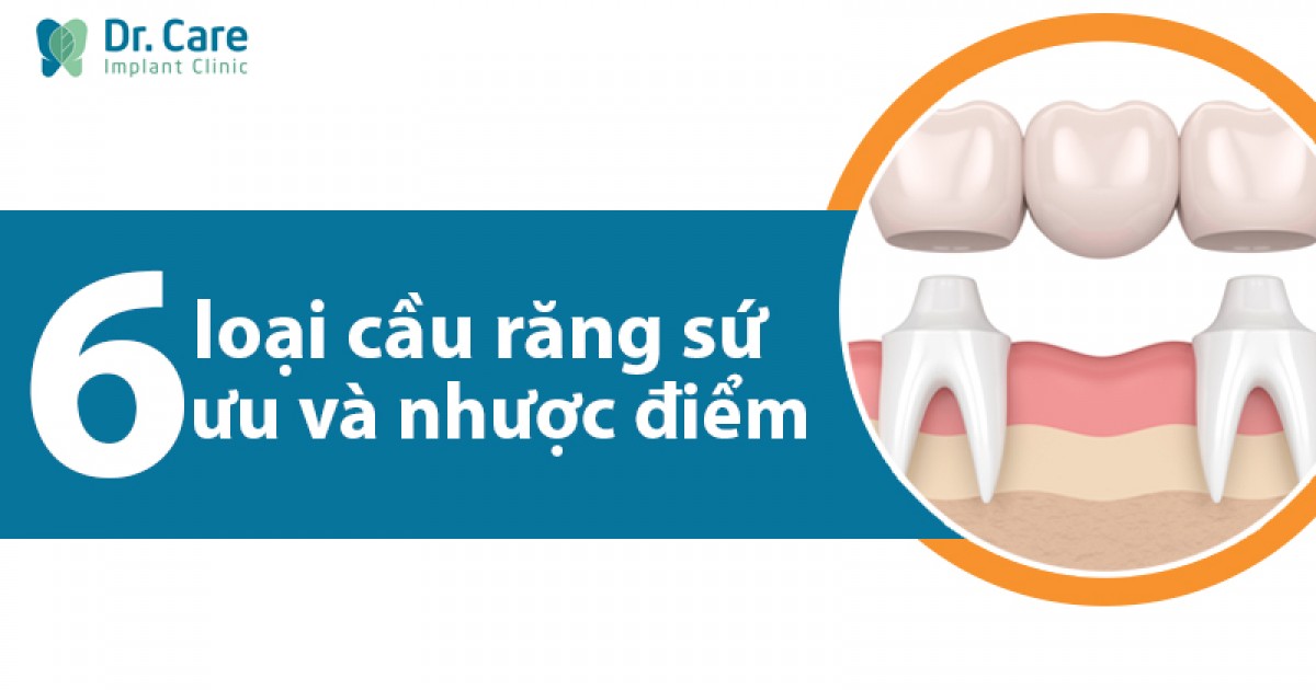 Có bao nhiêu loại cầu răng sứ?