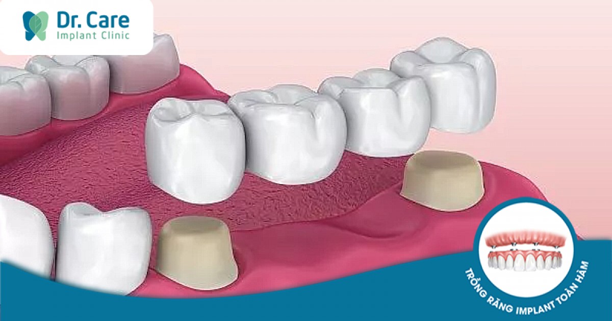 Cách chăm sóc và duy trì cầu răng sứ để tránh biến chứng tiêu xương?
