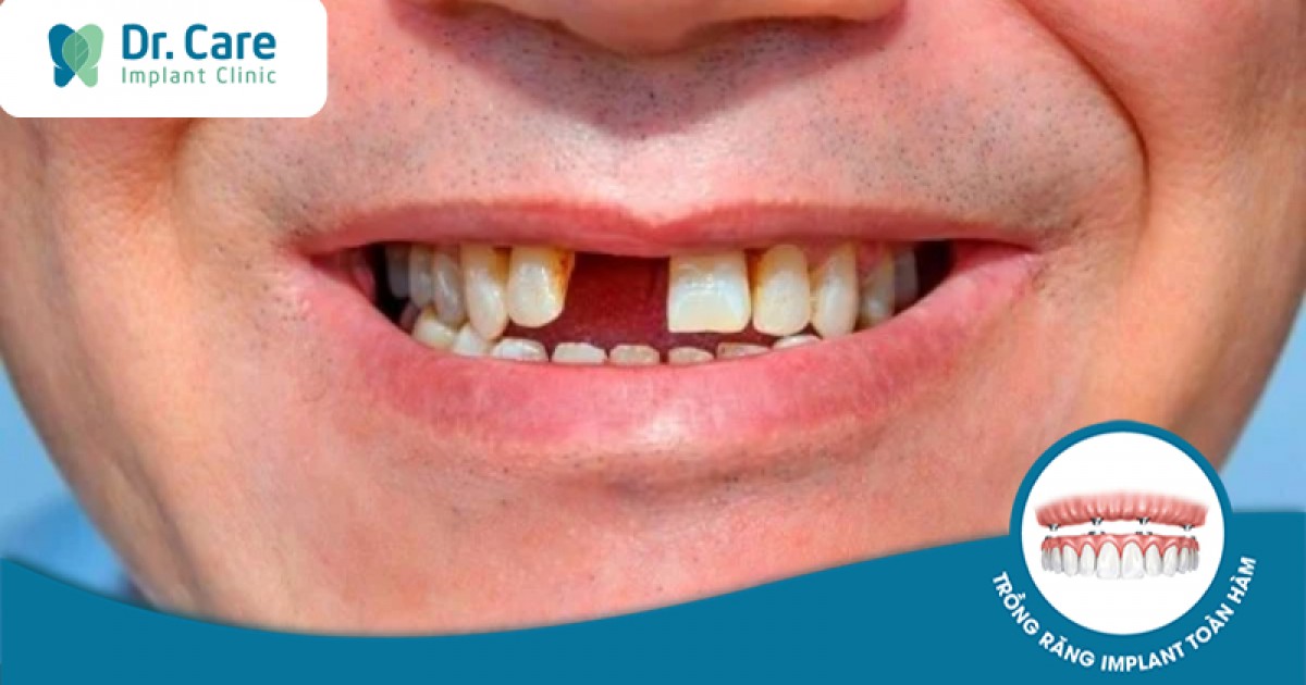 Mất bao lâu để hoàn tất quá trình trồng implant răng cửa?
