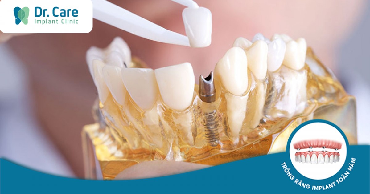 Những lợi ích của việc phục hình răng sứ trên implant là gì?
