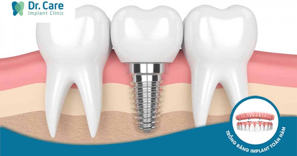 Có nên trồng răng Implant giá rẻ tại Bình Thạnh không? | Dr. Care